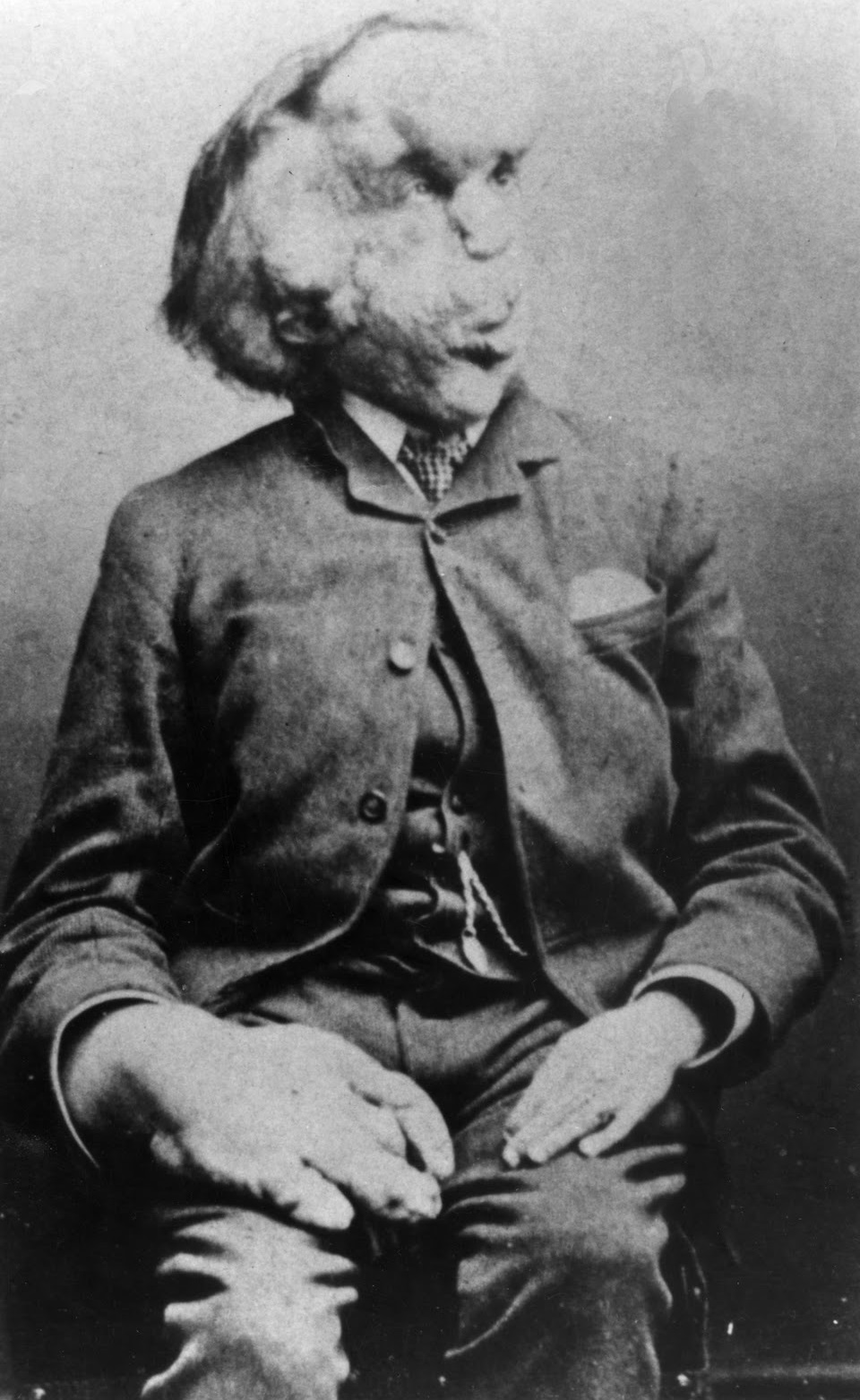Joseph Merrick photo